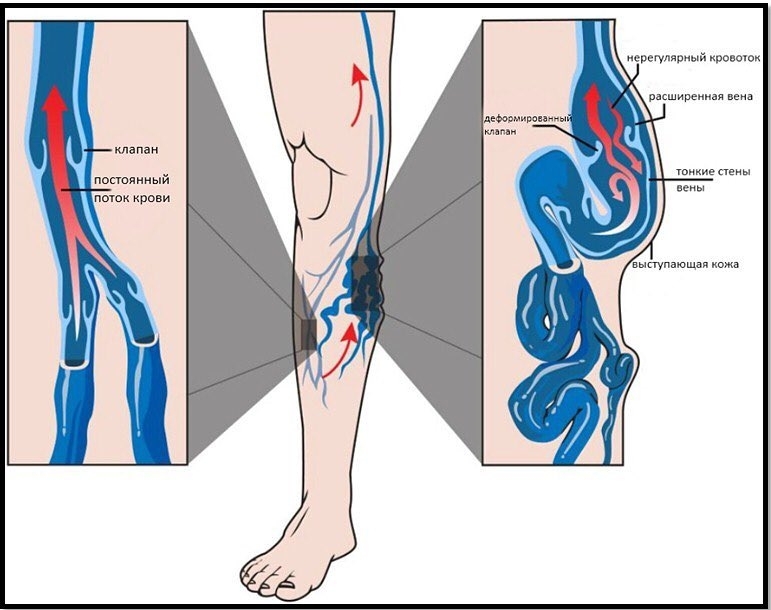 Варикоз Ранние Симптомы