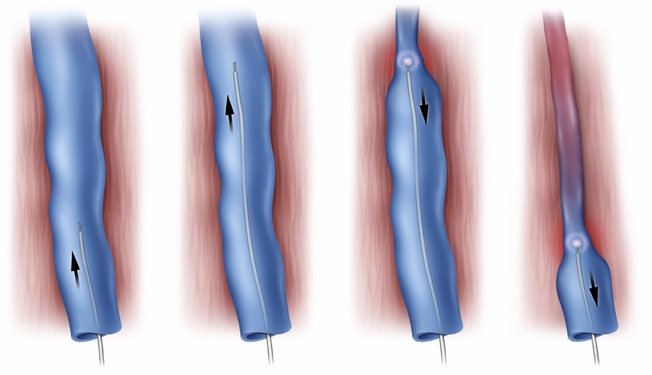 Эндовазальная Коагуляция Варикозных Вен